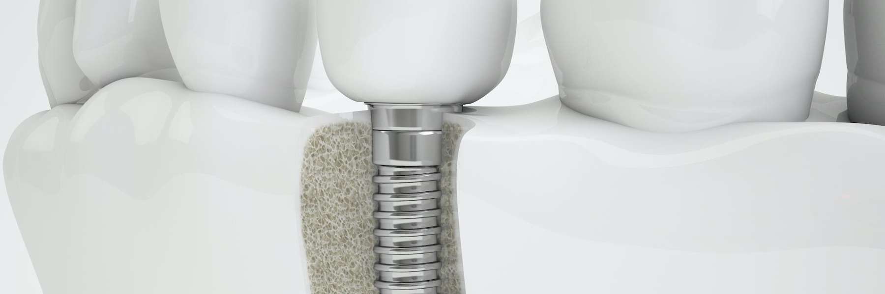 illustration of dental implant procedure