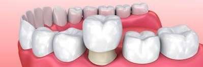 A model of Dental Crowns in Hermitage, PA