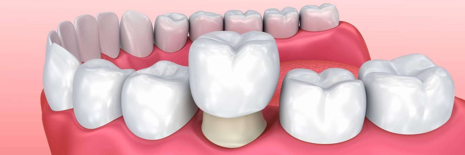 A model of Dental Crowns in Hermitage, PA