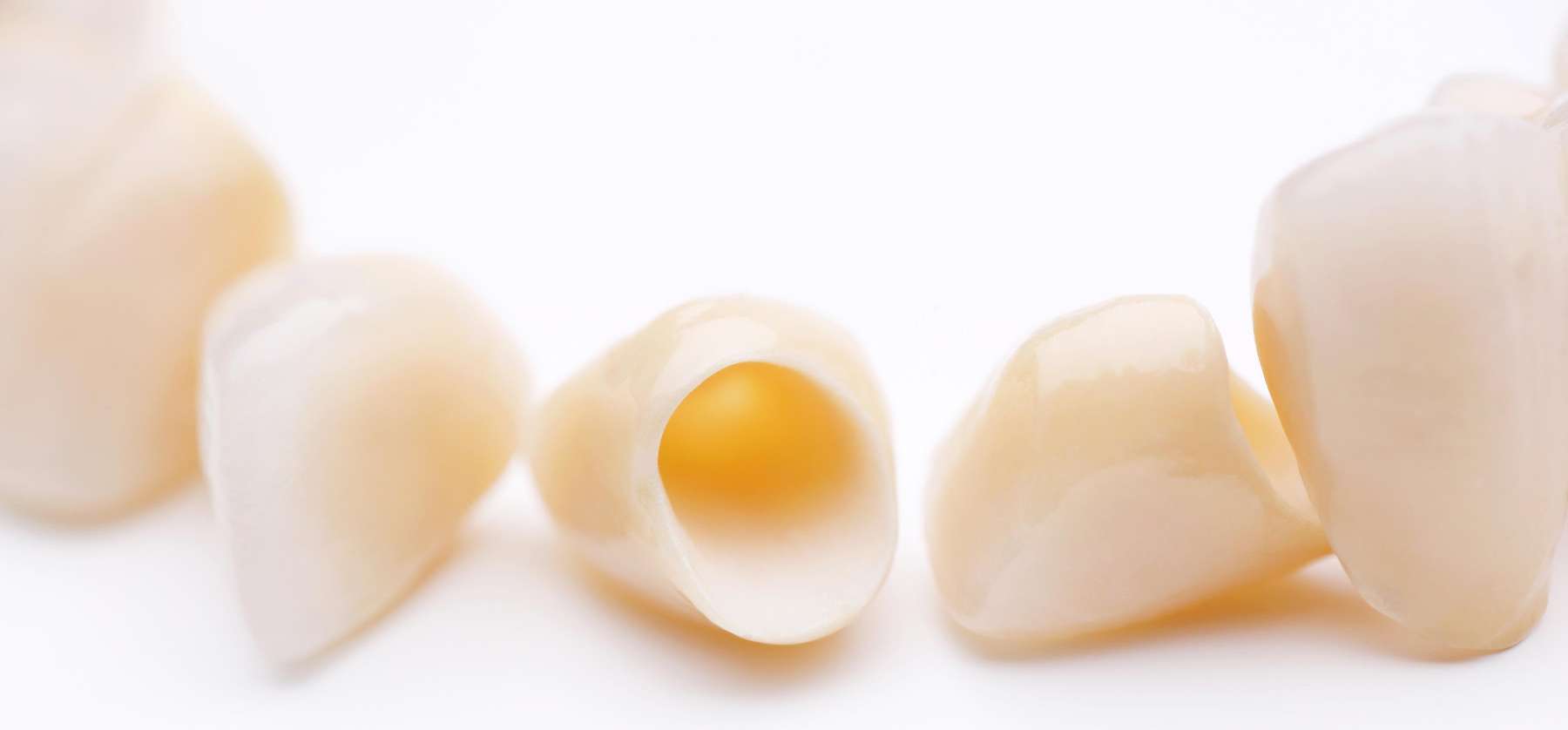 What Are Cheaper Alternatives to Veneers? Cosmetic Dentistry Hermitage PA