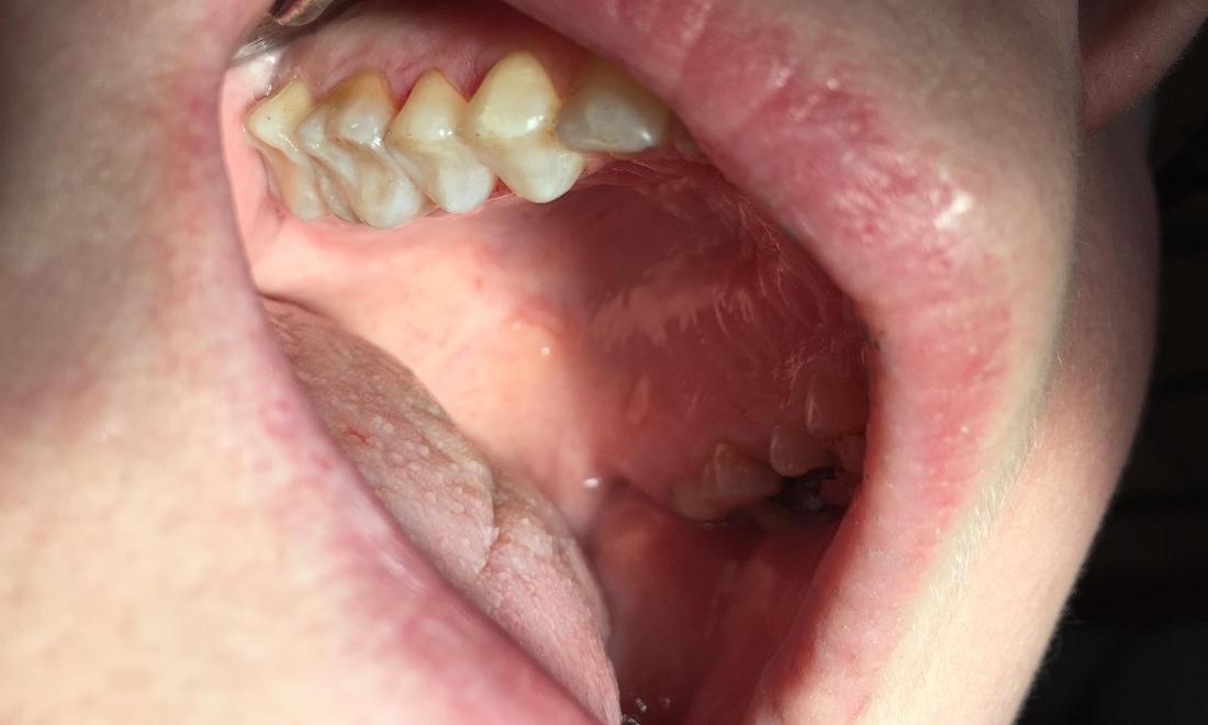 image of the same teeth after tooth colored fillings | Hermitage PA
