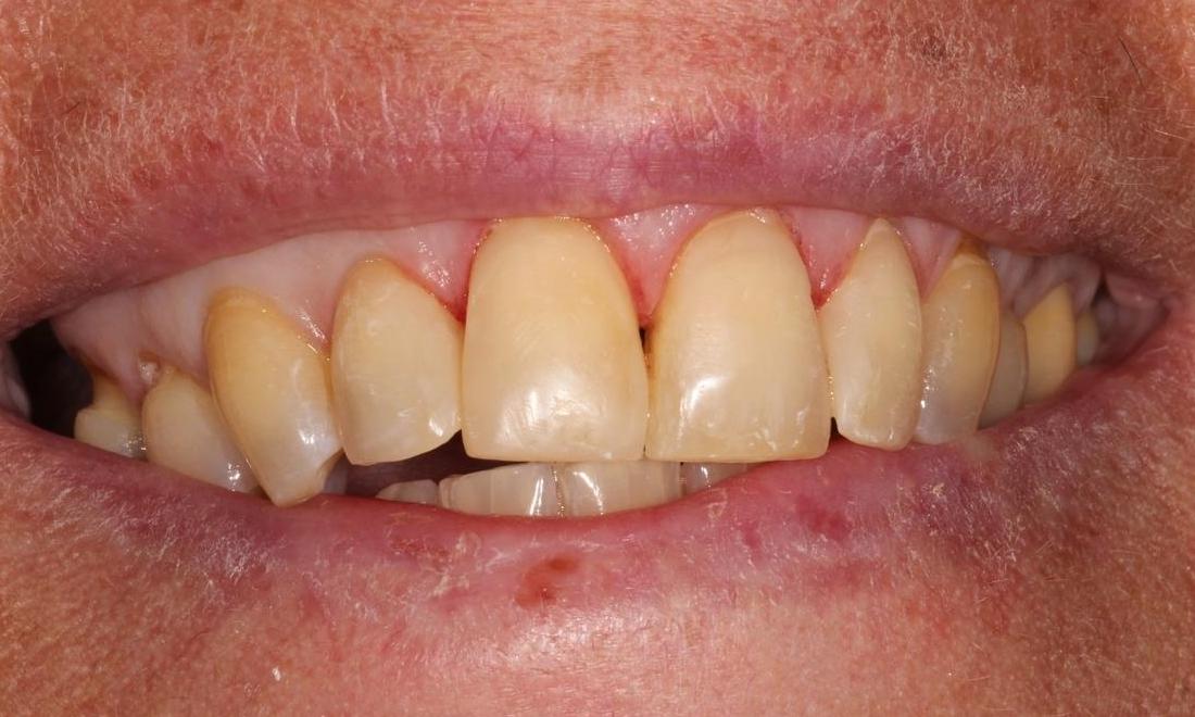 image of the same teeth following dental bonding | Hermitage PA