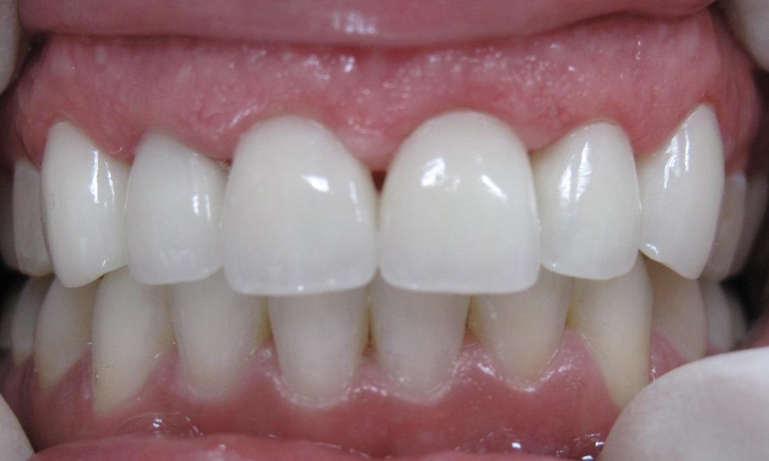 After Teeth Maintenance in Thomas Family Dentistry Hermitage PA