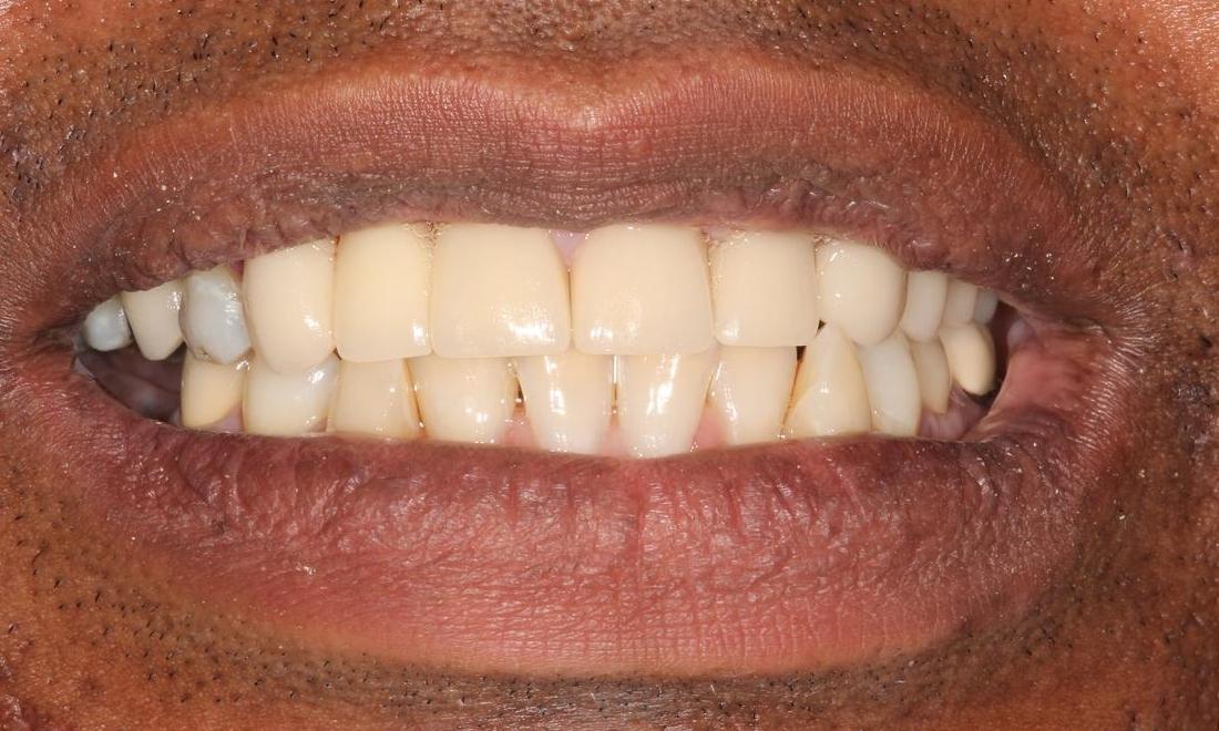 Image of the same teeth after crowns and bridges | Hermitage PA
