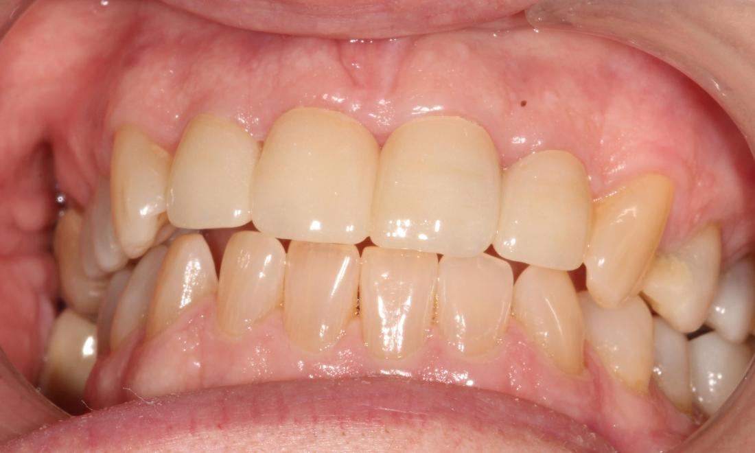 After Cosmetic Veneers in Thomas Family Dentistry Hermitage PA