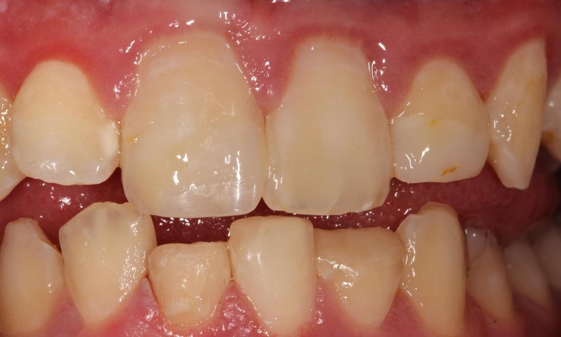 After Tissue Health Restoration in Thomas Family Dentistry Hermitage PA