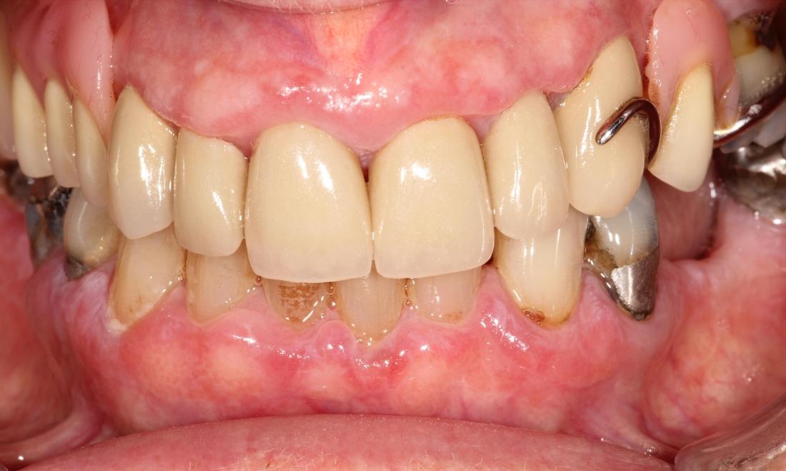 After Upper Crown Work in Thomas Family Dentistry Hermitage PA