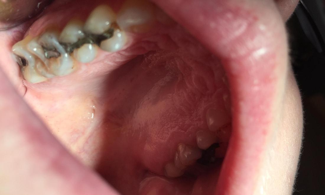 image of teeth with decay and silver fillings | Hermitage PA