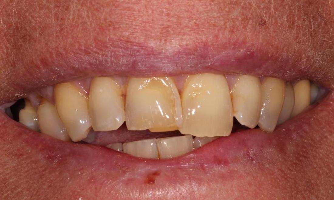 Image of chipped teeth | Hermitage PA