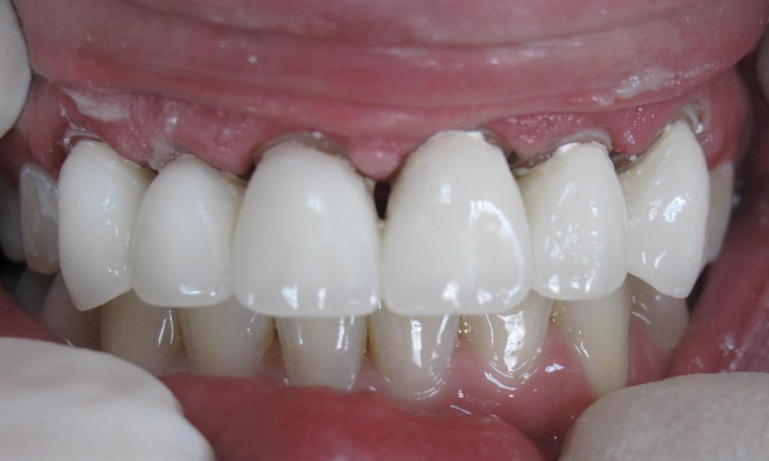 Before Teeth Maintenance in Thomas Family Dentistry Hermitage PA