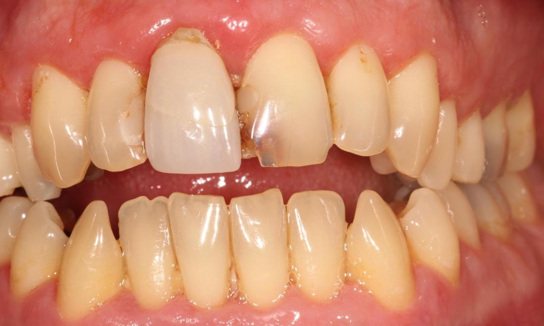 Before Crown Work in Thomas Family Dentistry Hermitage PA