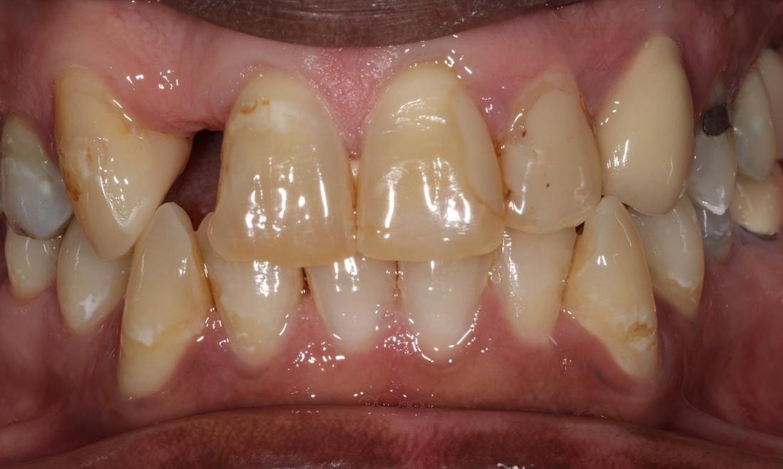 image of broken, decayed, and missing teeth | Hermitage PA