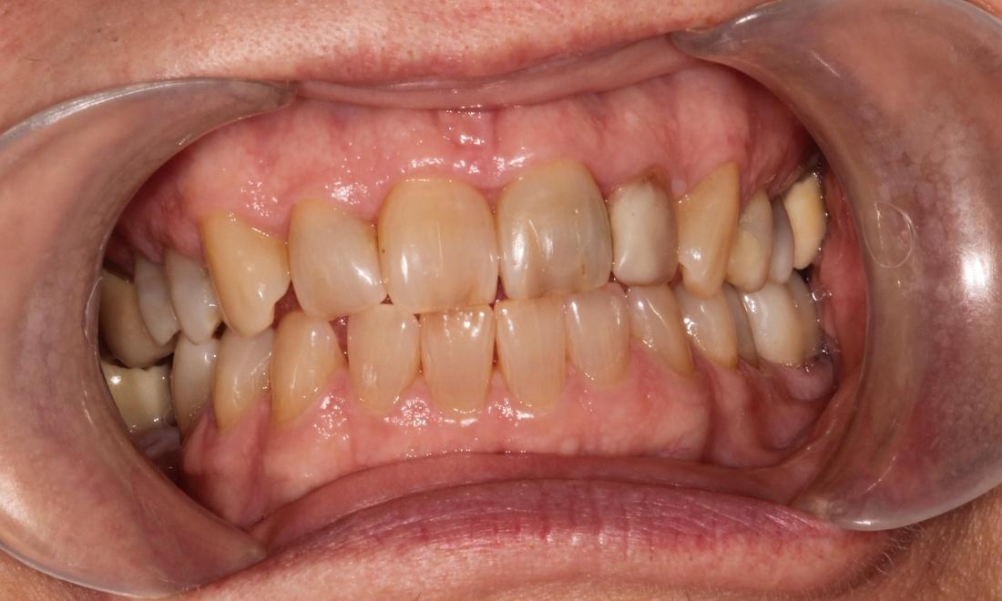 Before Cosmetic Veneers in Thomas Family Dentistry Hermitage PA