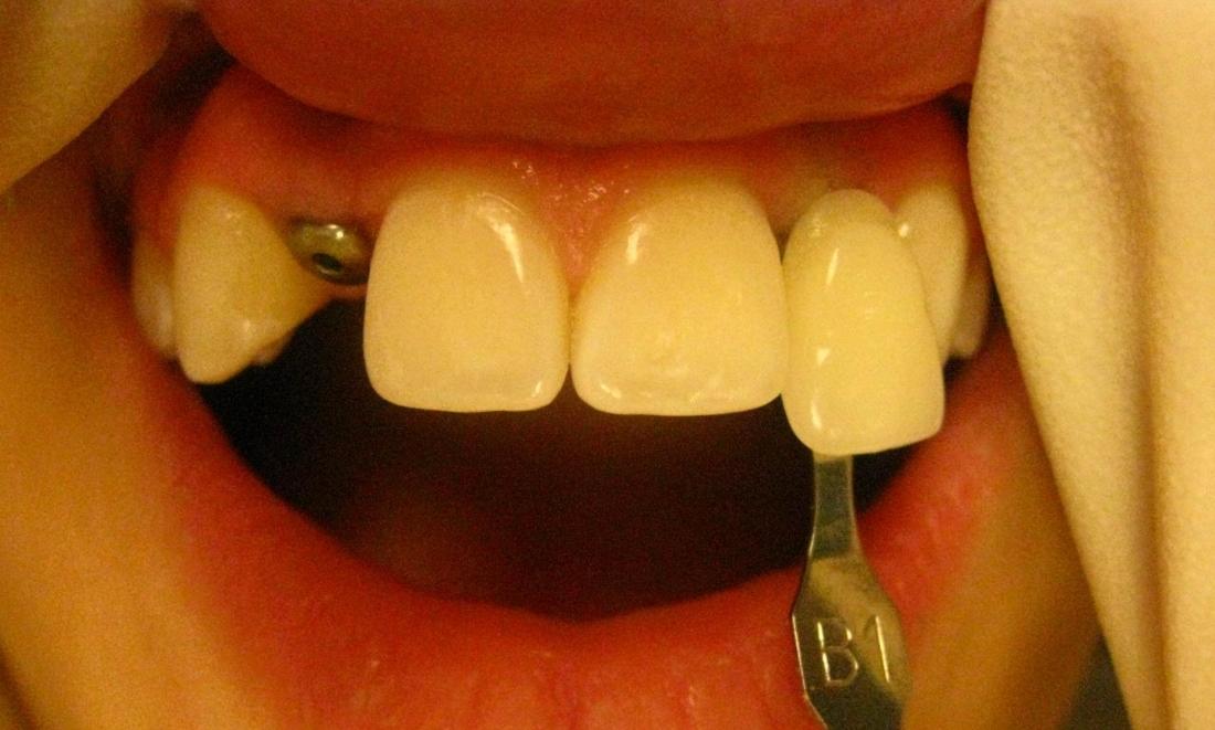 Tooth Replacement | Smile Gallery Before & After | 16148 Dentist