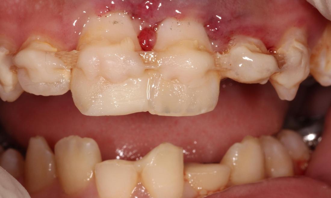 Before Tissue Health Restoration in Thomas Family Dentistry Hermitage PA