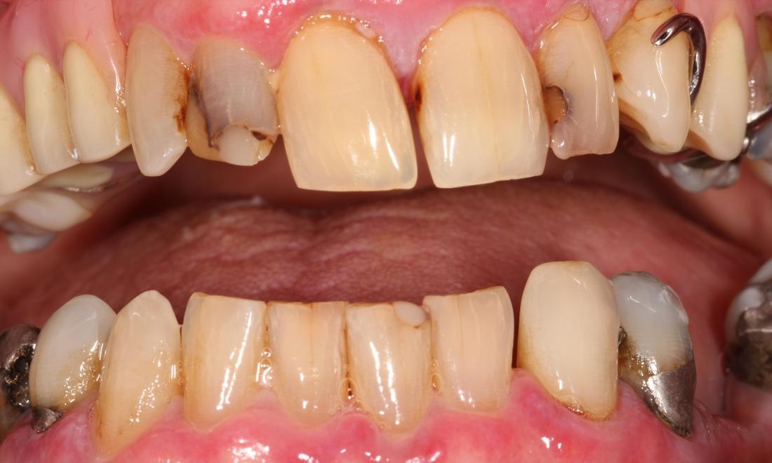 Before Upper Crown Work in Thomas Family Dentistry Hermitage PA