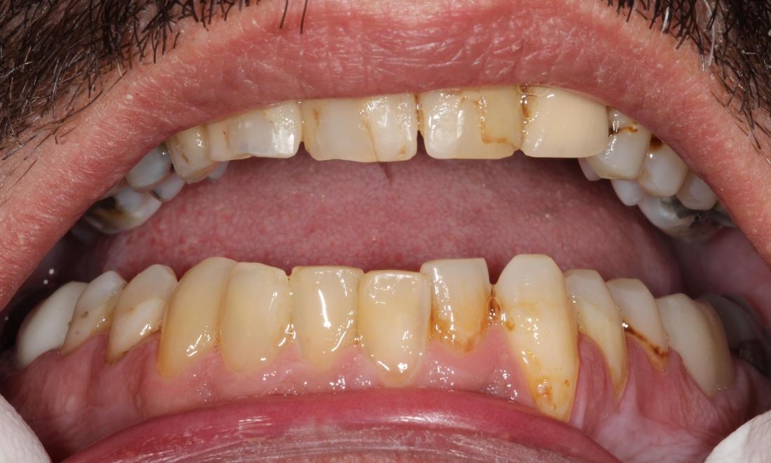 Image of same teeth with composite restorations placed.