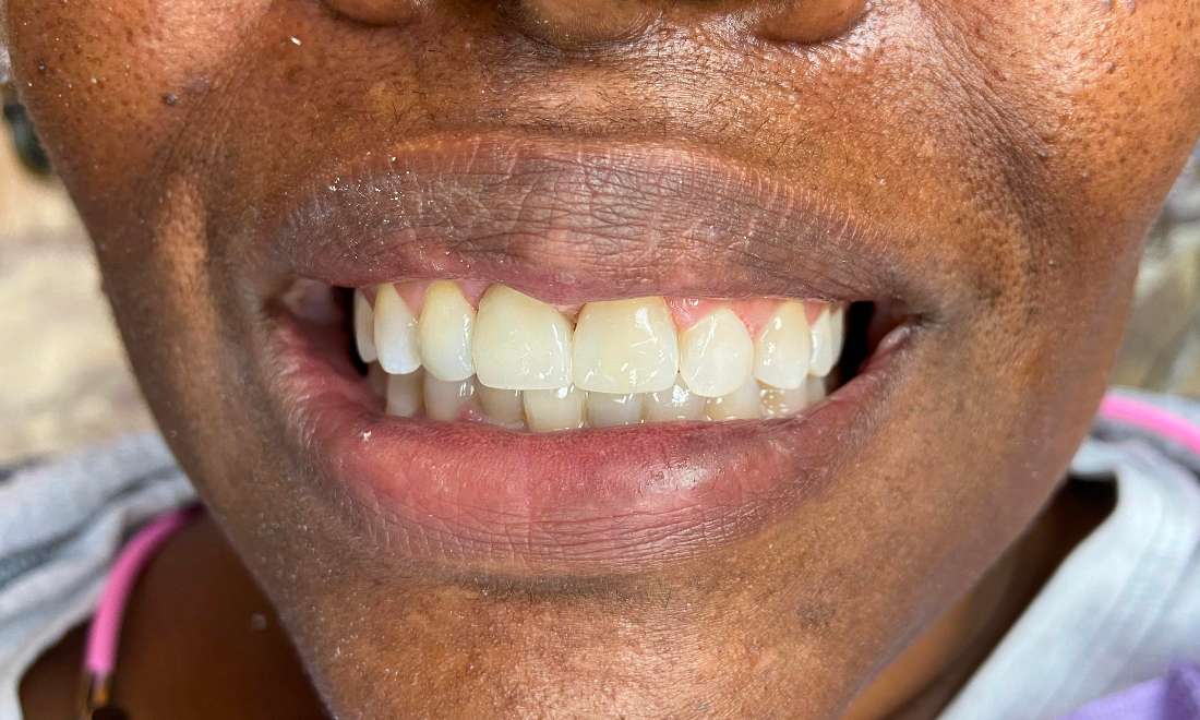 Patient's teeth after getting dental bridges in Hermitage, PA