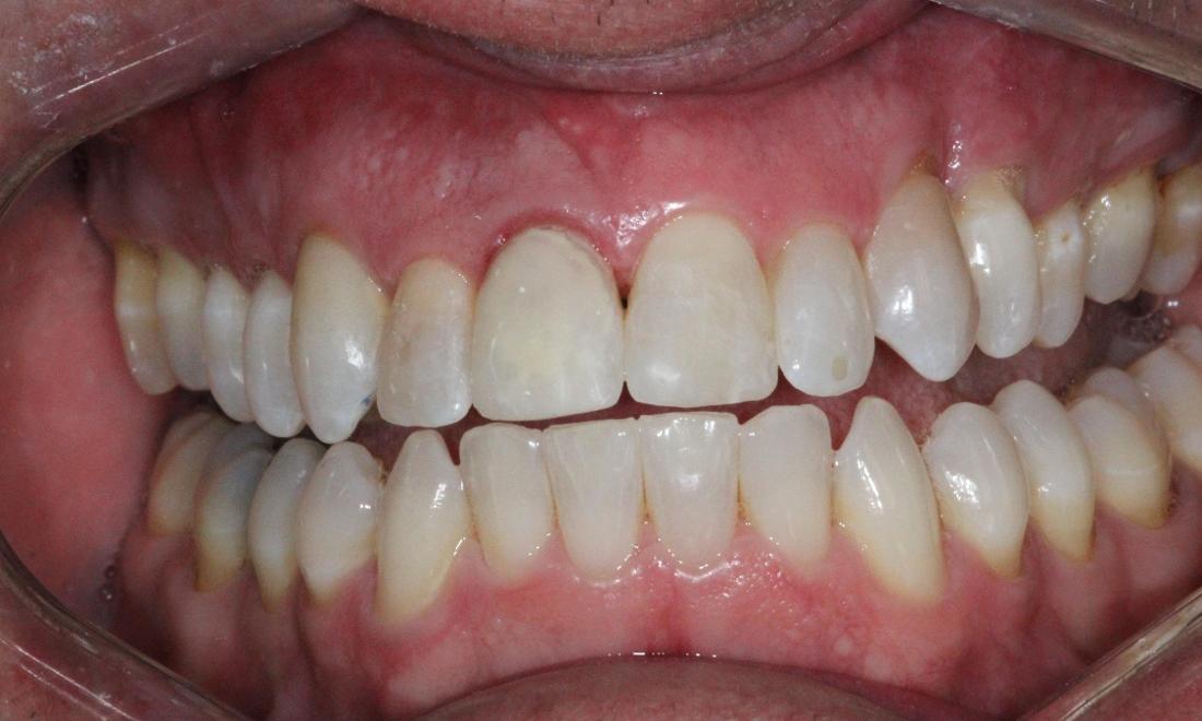 Image of same tooth with bonding.