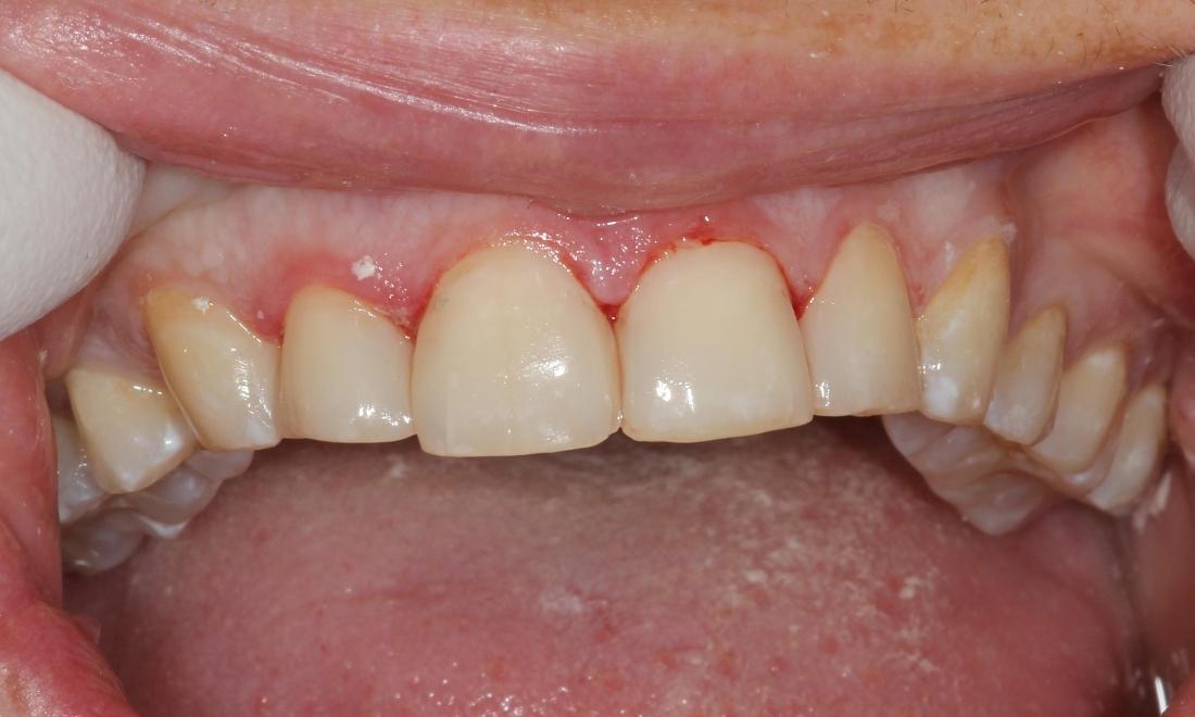 Image of same teeth with composite restorations placed.
