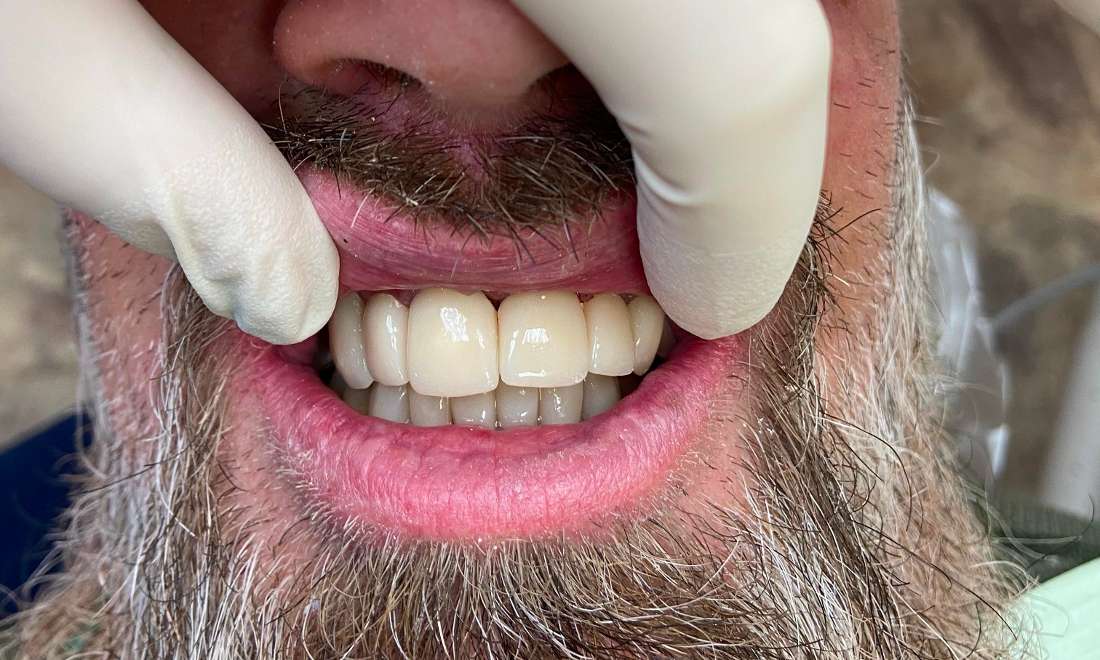 Patients teeth after eliminating tooth decay in Hermiatge, PA