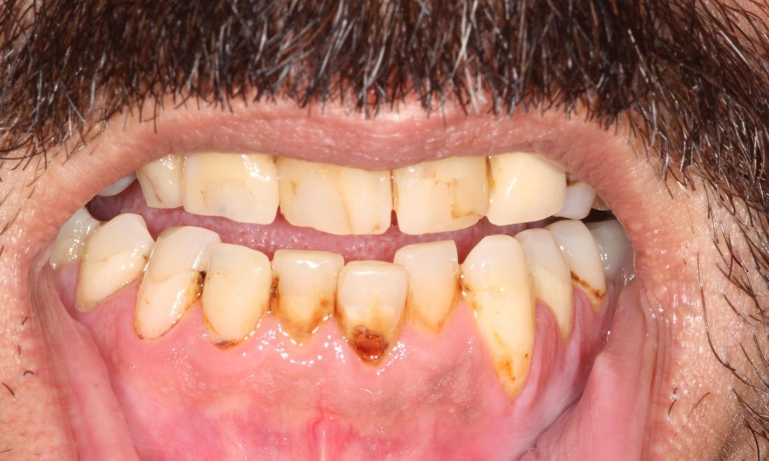 Image of multiple decayed and stained teeth.