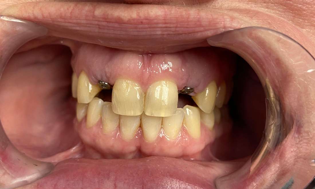 Patient's teeth before getting dental implants
