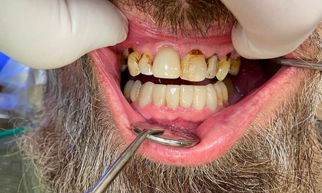 Patients teeth before eliminating tooth decay