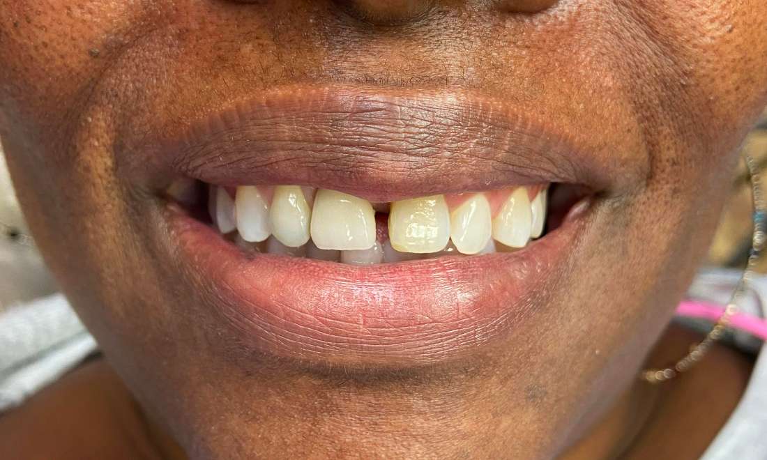 Patient's teeth before getting dental bridges