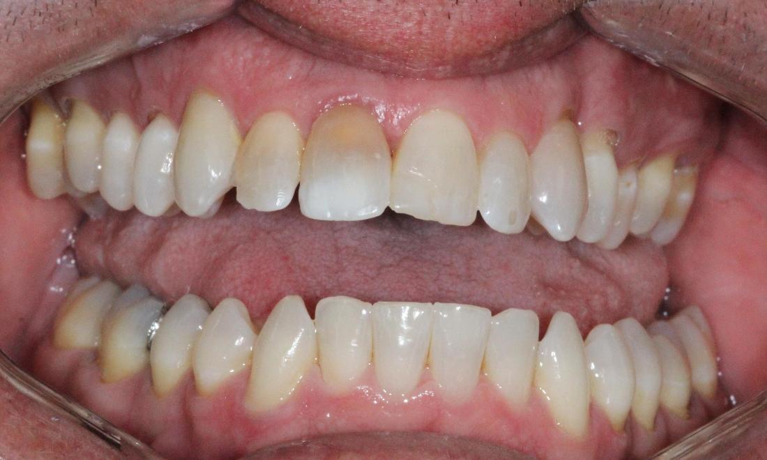 Image of front tooth with internal staining.