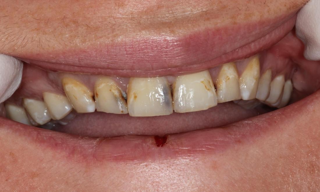 Image of teeth with decay and staining.