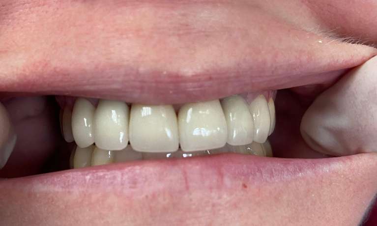 Dental-Implant-Before-and-After-After-Image